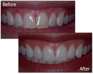 teeth whitening cache valley utah