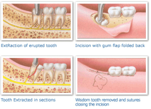 cache valley tooth extraction